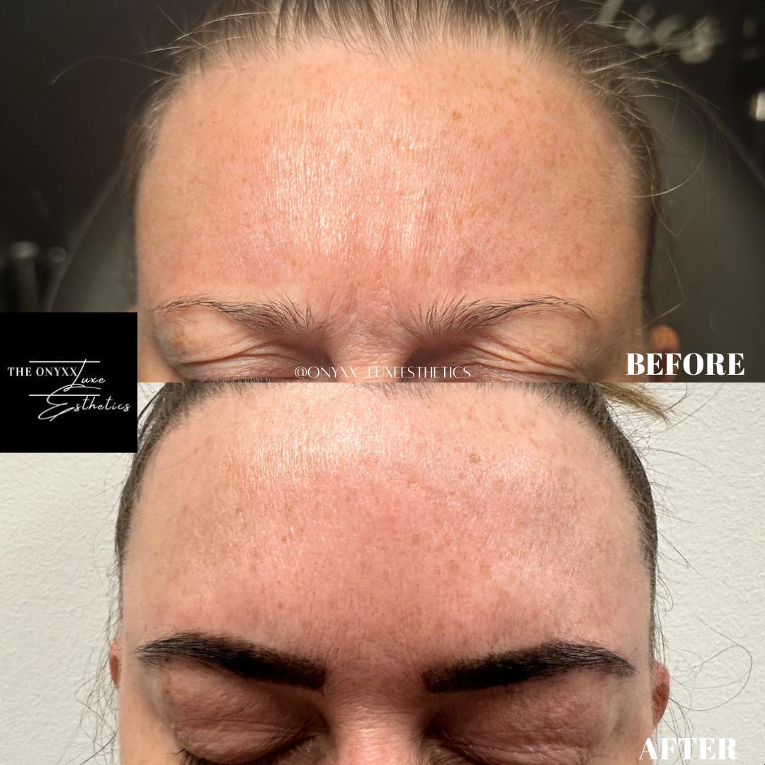Botox3