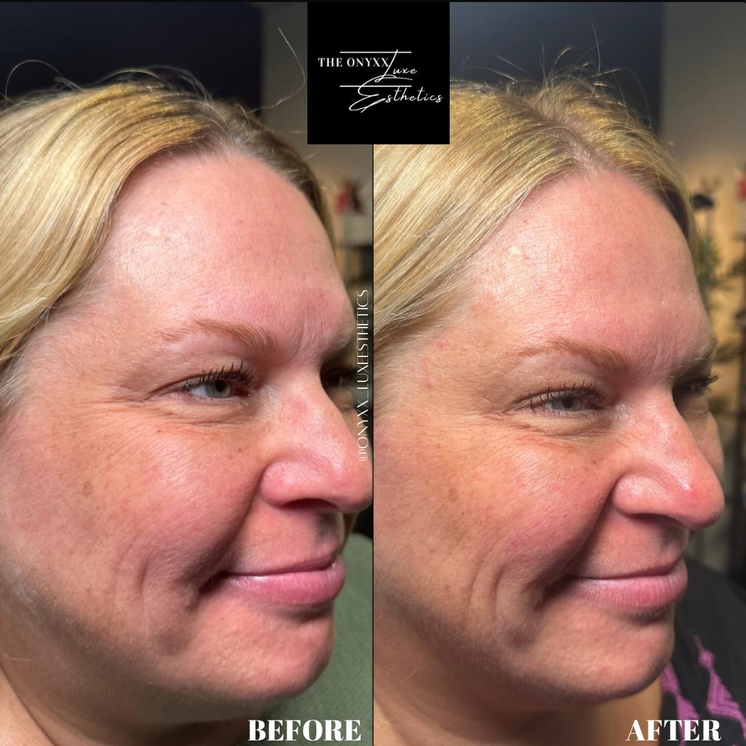 Botox7