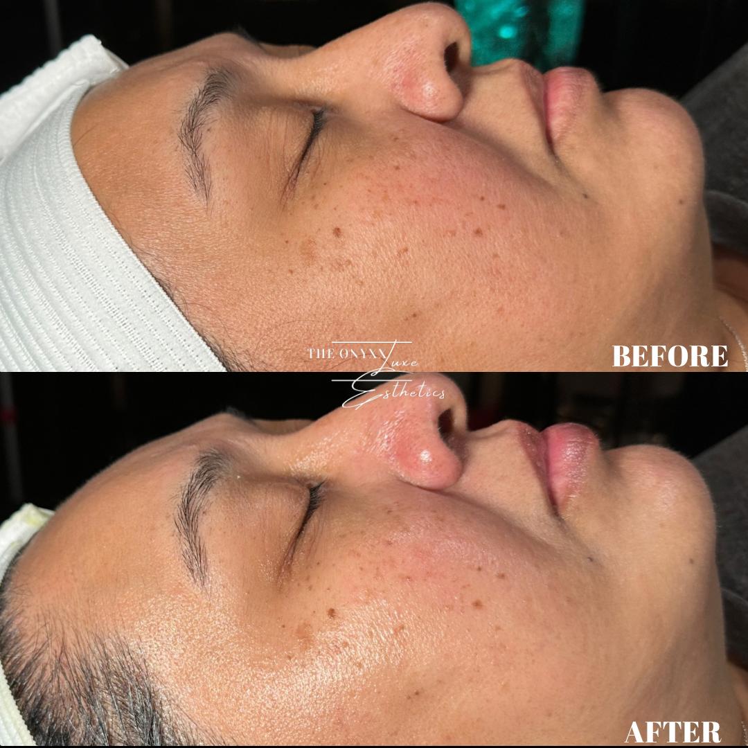 Facial 3