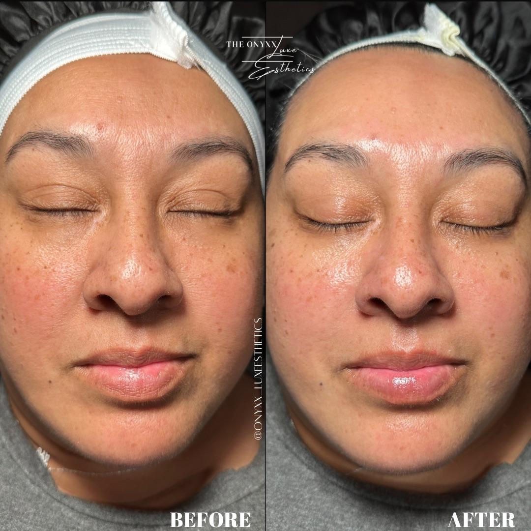 Facial 5