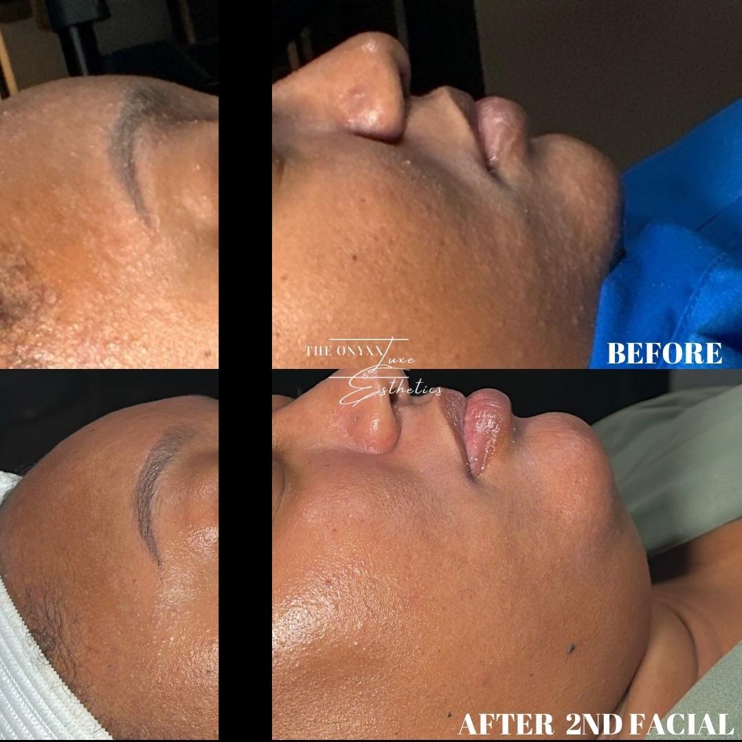 Facial 6
