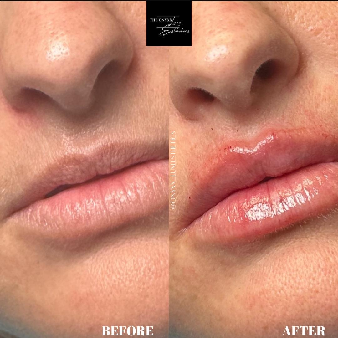 Filler2